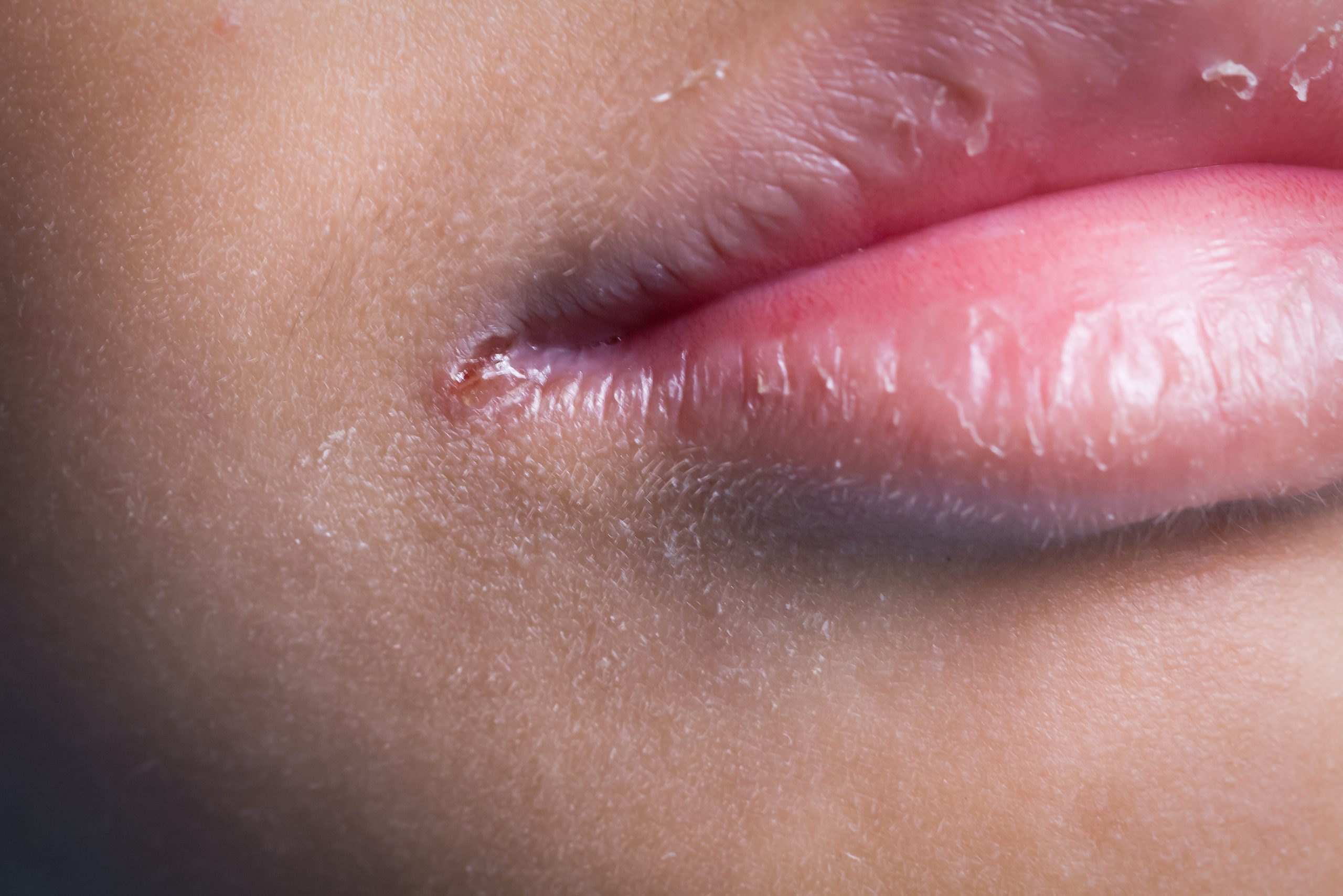 How To Treat Angular Cheilitis At Home