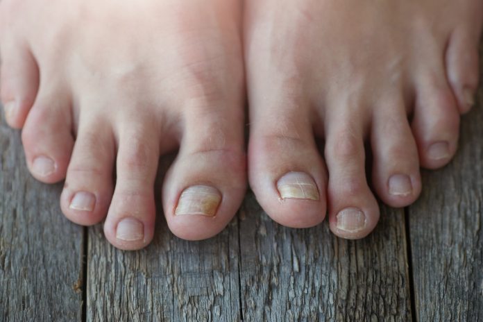 Can Natural Remedies Cure Nail Fungus Nutroo