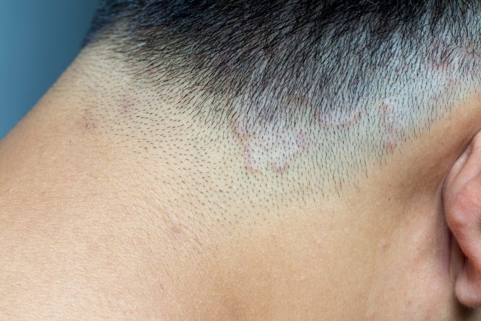 Which Are The Best Ways To Get Rid Of Tinea Versicolor Nutroo