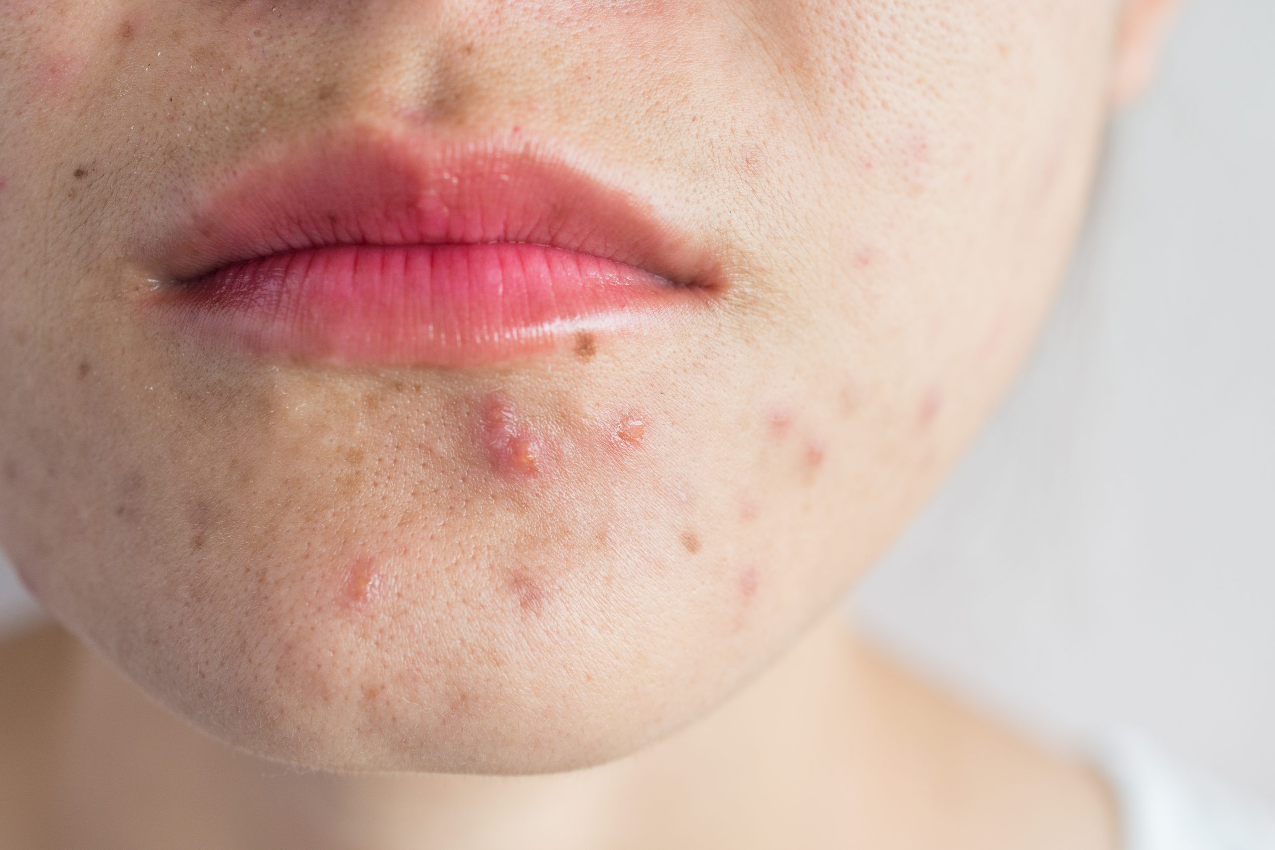 Can These Home Remedies Cure Acne Scars Nutroo