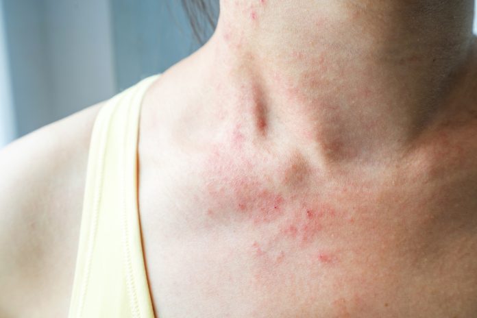 Can Eczema Be Cured With Natural Remedies Nutroo