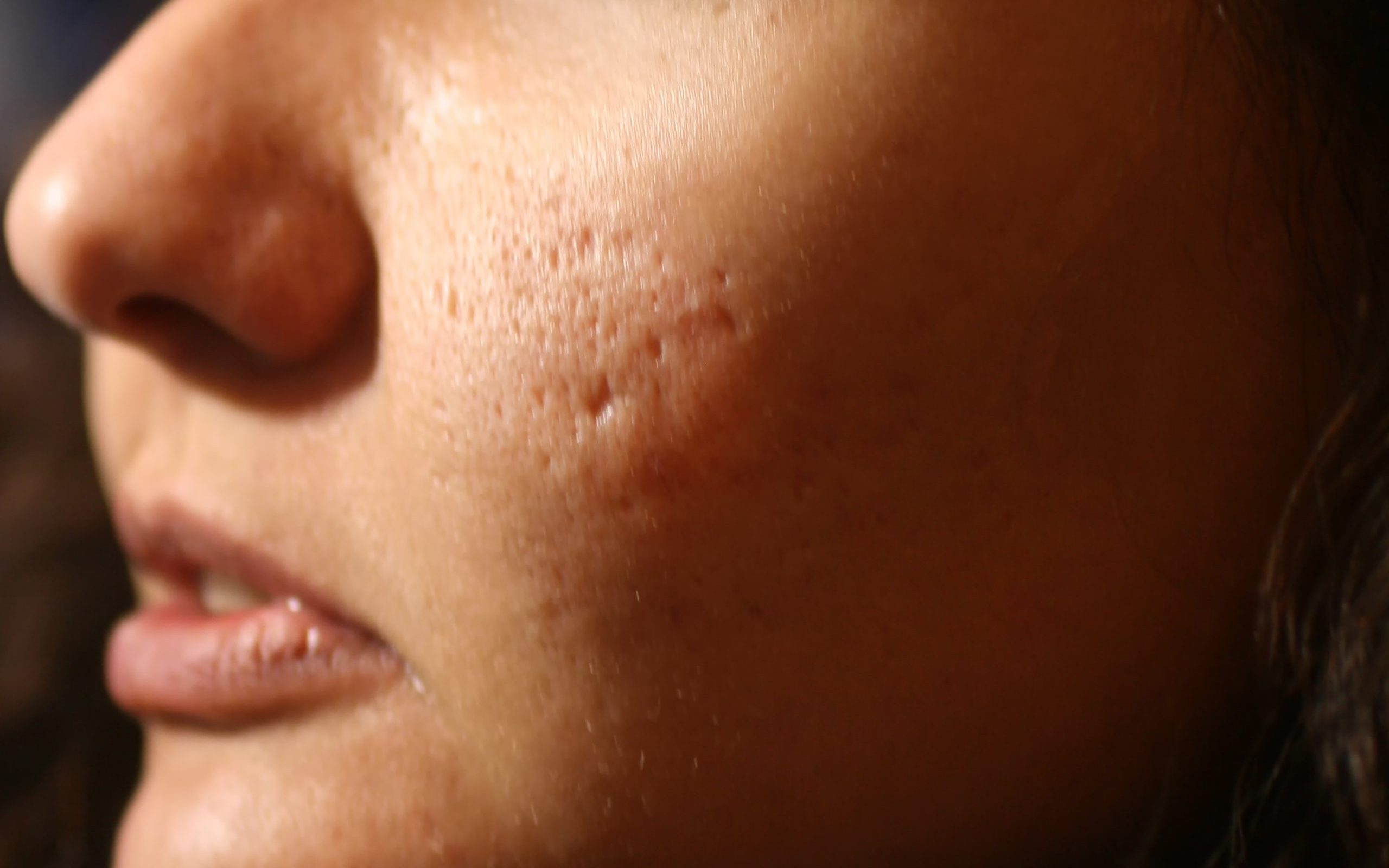 Are There Effective Home Remedies That Work On Pimple Scars Nutroo