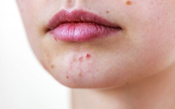 How To Heal Your Acne Naturally Nutroo