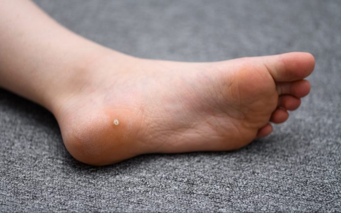 Wart on under foot, Foot fungus traducere în engleză, Wart under foot symptoms